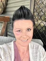 Kooralbyn residents worried about severe reactions to tick bites