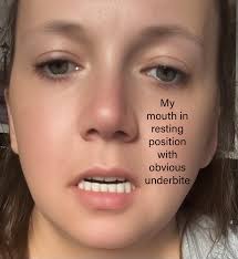 Are sores from new dentures normal and how to alleviate them?