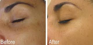 Hydrafacial Before And After Realresults Hydrafacial Facial Skincare Beauty Face Skin Spa Spasp Hydra Facial Skin Resurfacing Laser Skin Resurfacing