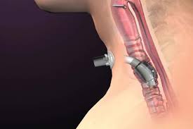 Image result for Tracheostomy