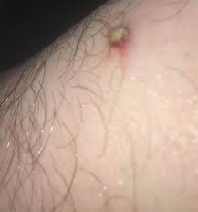 An ingrown hair is a hair that curls back on itself. Ingrown Hair Thingy Burst In The Shower Popping