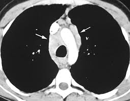 Image result for Humoral Immunodeficiency