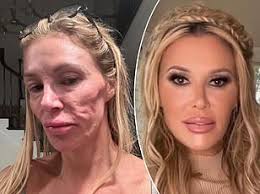 Brandi Glanville talks suffering 'deep depression' while battling facial  disfigurement: 'I look like a crackhead'