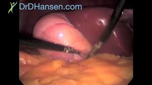 How do i get ready for a cholecystectomy? Gallbladder Removal Surgery Utah Dr Darrin Hansen
