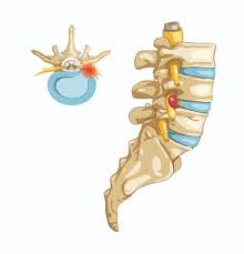 Image result for vyhřezlá ploténka