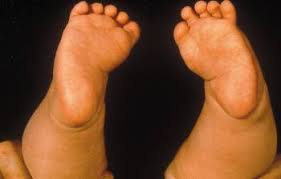 Club′ foot′, furniture. furniturea knoblike foot formed from the end of a cabriole leg as a continuation of its lines: Talipes Equinovarus Clubfoot And Other Foot Abnormalities Pediatrics Msd Manual Professional Edition