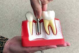 We did not find results for: How To Fix Loose Dental Implants Smile Design Dentistry