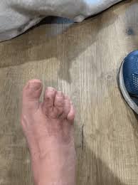 Image result for diabetic toes