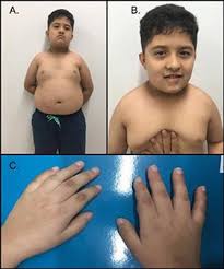 Der name wird auch willy geschrieben. Frontiers First Case Report Of Prader Willi Like Syndrome In Colombia Genetics