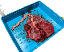 Image result for Retained Placenta