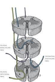 Traumatic Brown Sequard Syndrome Modern Reminder Of A Neurological Injury Bmj Case Reports