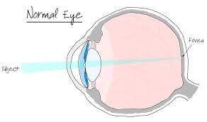 Image result for Refractive Error