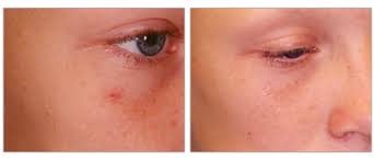 How can a cherry angioma be removed? Vein Center Cosmed Facial Red Spots Cherry Hemangiomas Treatment