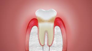 Leave it for a couple of minutes, and then rinse your mouth with pure water. What Causes Gum Inflammation Corsodyl