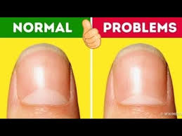 Your Nails Say About Your Health Symptoms Nail Diseases