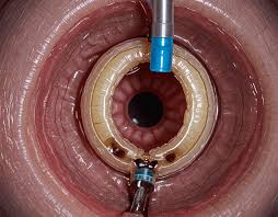 Image result for Wireless Capsule Endoscopy