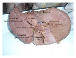 The ligamentum teres or round ligament is the fibrous cord formed by the obliterated fetal umbilical vein that runs in the free edge of the falciform ligament from the umbilicus into the left lobe of the liver. A New Insight Into The Morphology Of The Human Liver A Cadaveric Study