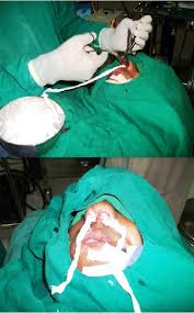 Image result for Nasal Packing