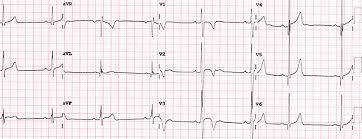 The surface ecg in the diagnosis of cardiac arrhythmias: Cardiovascular Medicine Current Ecg Interpretation Guidelines In The Screening Of Athletes