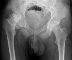 Perthes' disease is an uncommon condition that affects children between the ages of three and 11 years. Perthes Disease Pacs Entwicklung