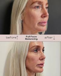 Check out this stunning before and after of a client who came in for Full  Face Facial Balancing using Botox and Juvederm Filler. The key to this  transformation? Subtle, expertly placed treatments