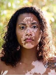 Vitiligo is an acquired depigmenting disorder of the skin, in which pigment cells (melanocytes) are lost. How These 7 Women With Vitiligo Are Embracing Their Skin Vitiligo Treatment Vitiligo Model Vitiligo
