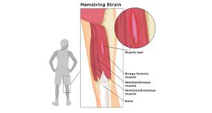 After proper diagnosis of a quadricep strain or tear, your doctor will assess your particular case and determine a course of action. Do You Experience Lower Limb Muscle Strains Preventing And Treating Common Muscle Strains Spd