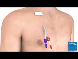 If the catheter is in your chest, sometimes it is attached to a device called a port that will be under your skin. How A Tunnelled Central Line Is Placed Youtube