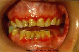 Image result for Gingivitis