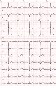 Image result for Left Axis Deviation