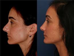 Rhinoplasty Before and After Photos by Ronald Schuster, MD; Lutherville, MD 
