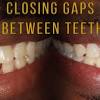 ♡in this video i talk about my experience with braces and how i my gap reopened after braces. 1