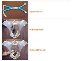 Image result for Pelvimetry