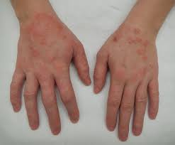 Ever had rash under armpit? Dermatitis Wikipedia