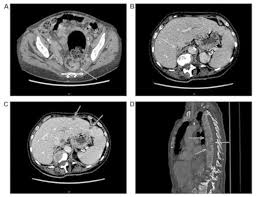 Surgical resection may be curative alth. Cervical Bone Pain Revealing A Bone Metastatic Colon Cancer A Case Report