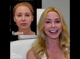 Darnell's TCF lift by Dr. Mani