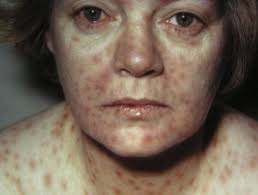 A case report and review of the context appropriate interventions to prevent syphilis: Syphilis Images Dermnet Nz
