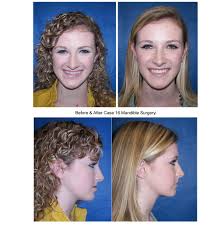 Does blue shield cover jaw surgery. Double Jaw Surgery Before And After Love Meme