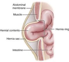 Symptoms of impaired inguinal hernia. Abdominal Wall Reconstruction And Hernias Veterian Key