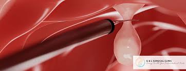 Image result for Colonic Polyp