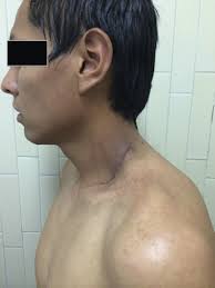 Cervical lymphangioma in the adult. A report of 2 cases