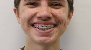 Brawling Between the Bathrooms: the Administration's Response to Vaping