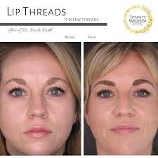 Maybe you would like to learn more about one of these? Charleston S Only Face Thread Lift Provider Totality Medispa