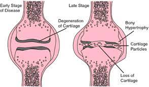 It is also most commonly found in the ribs, nose, larynx, and trachea. Hyaline Cartilage Definition Of Hyaline Cartilage By Medical Dictionary