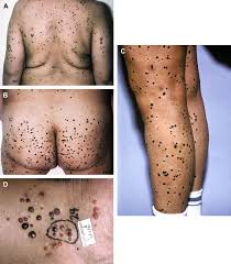 Image result for Spitz Nevus