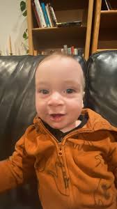 Craniosynostosis surgery options for 6 month old?