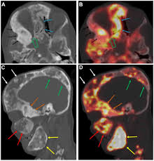 The pet scan uses a mildly radioactive drug to show up areas of your body where cells are more active than normal. Pet Ct And Pet Mri In Ophthalmic Oncology Review
