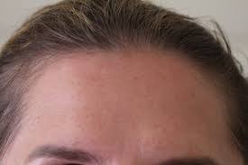 Botox Gegen Falten Bei Dr Doris Wallentin In Wien