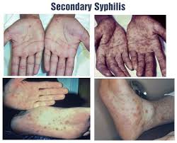 Image result for syphilis symptoms