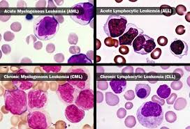 Image result for Leukemia
